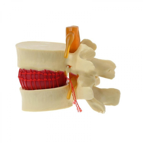 Wewoo - Modèle de démonstration de hernie discale lombaire humaine de colonne vertébrale orthopédique jaune Wewoo  - Jeux éducatifs